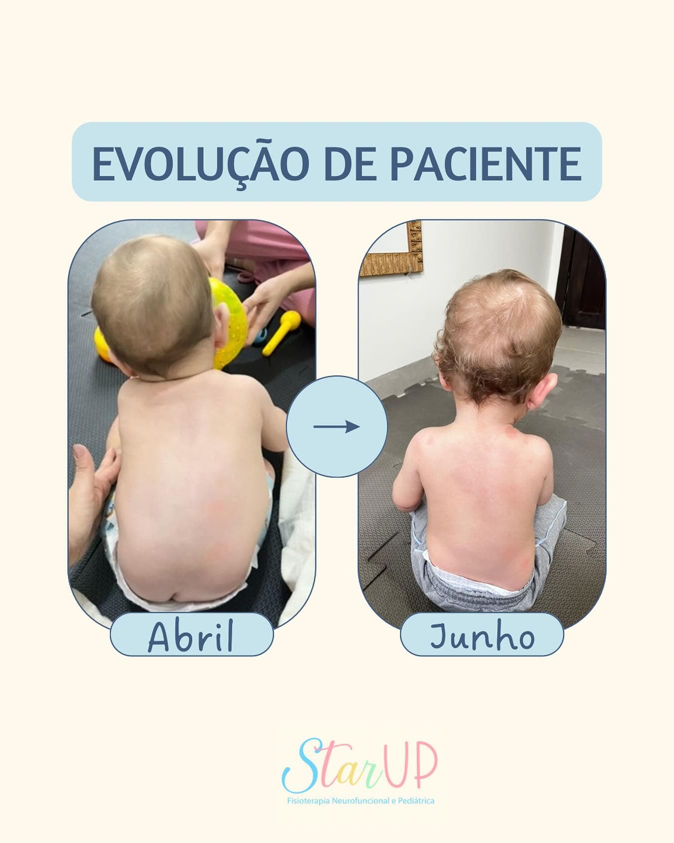 Uma linda evolução ✨ Na primeira imagem temos uma postura sentado, sem ação da musculatura do tronco, paciente desabado sob as pernas, inclinação do tronco acentuada a esquerda, e ombros extremamente tensos. 
